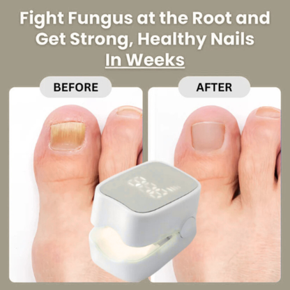 Orvinos™ - Nail Fungus Laser Device