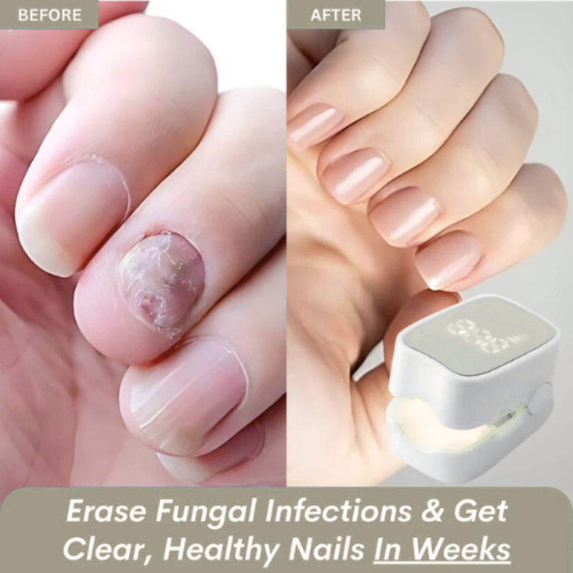 Orvinos™ - Nail Fungus Laser Device