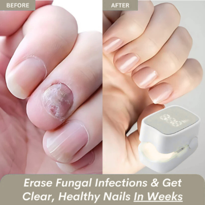 Orvinos™ - Nail Fungus Laser Device