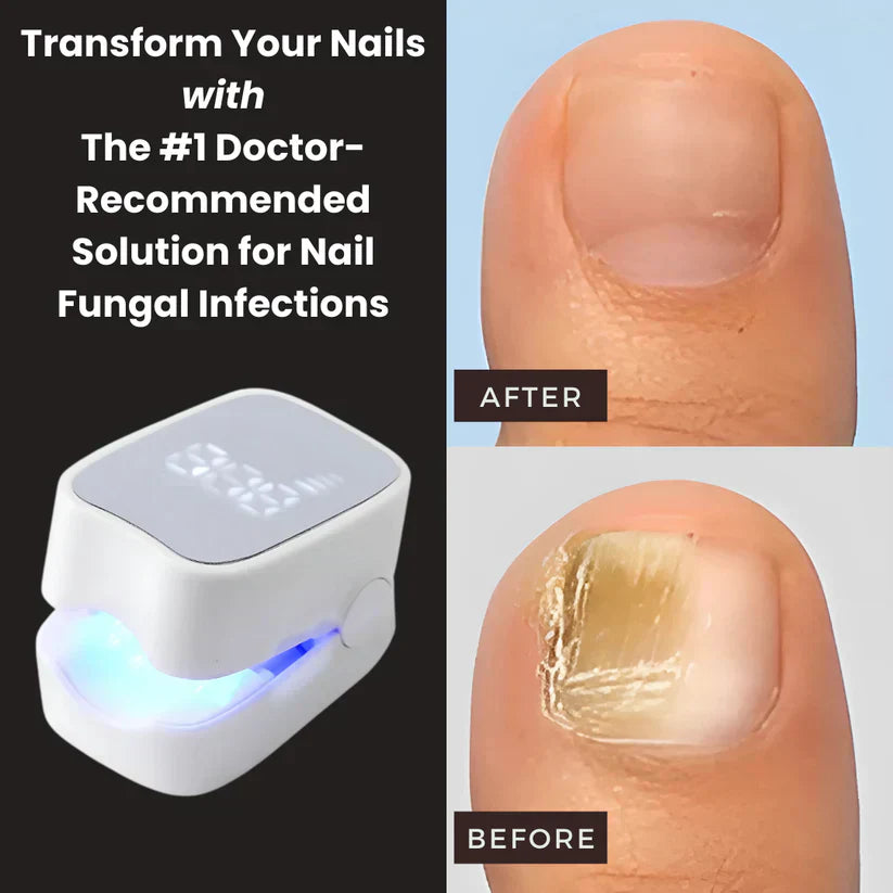 Orvinos™ - Nail Fungus Laser Device