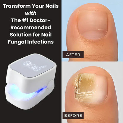 Orvinos™ - Nail Fungus Laser Device